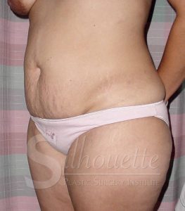 tummy tuck before and after orange co