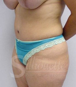 tummy tuck before and after orange co