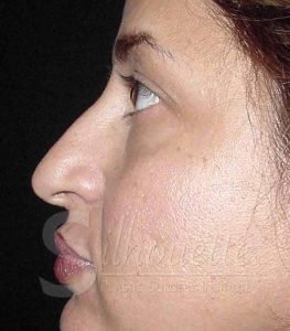 rhinoplasty before and after riverside