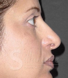 rhinoplasty before and after riverside