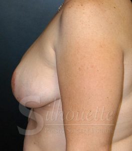 silhouette breast reduction photos