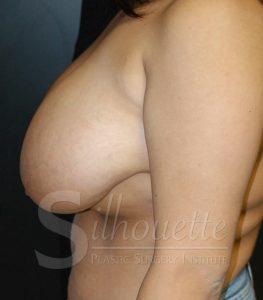 bakersfield breast reduction b&a