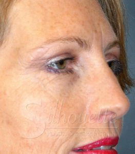 eyebag removal plastic surgery california