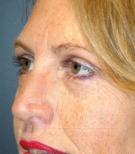 eyebag removal plastic surgery california
