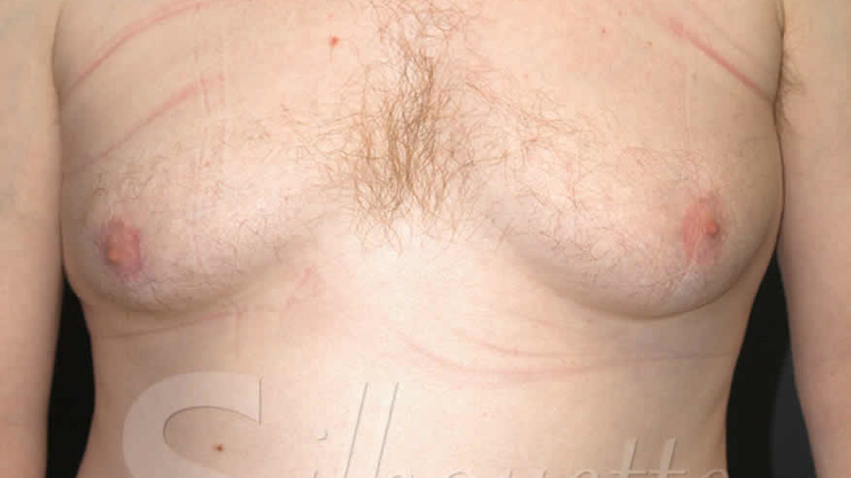 Male Breast Reduction, Before and After