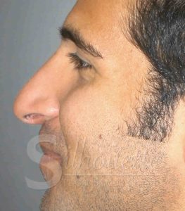 rhinoplasty bakersfield before and after