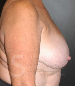 silhouette breast reduction photos