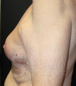 Orange Co Breast Lift Before and After