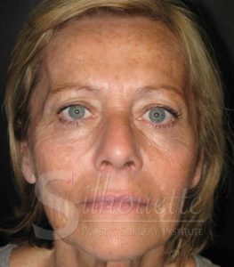 laser skin resurfacing orange co