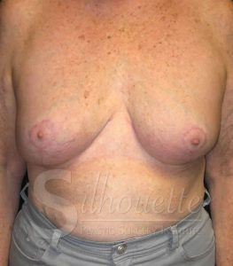Bakersfield Breast Revision Before and After