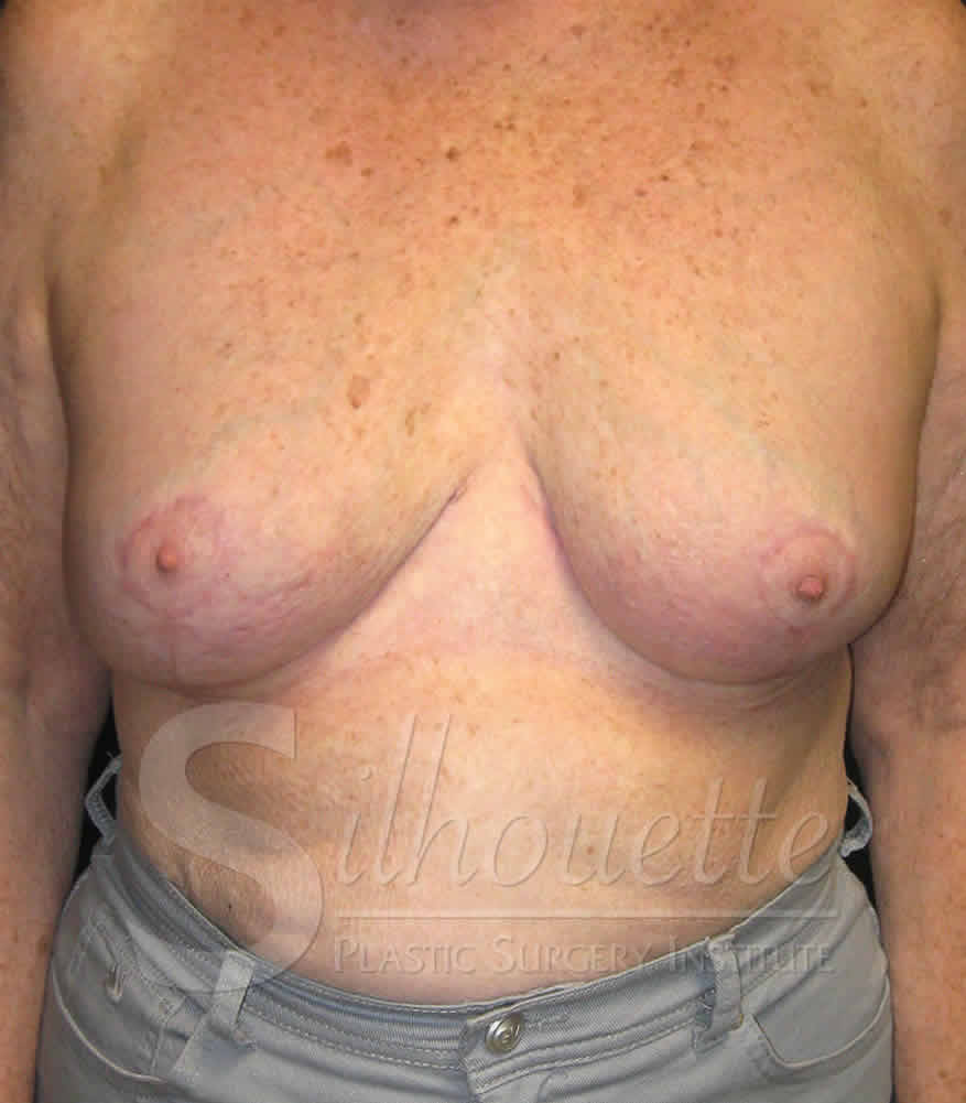 Bakersfield Breast Revision Before and After