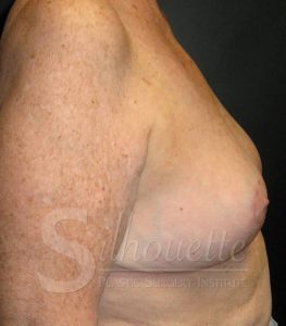Bakersfield breast augmentation gallery