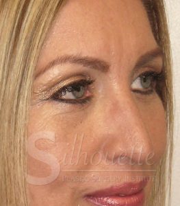 eyelid procedure orange co