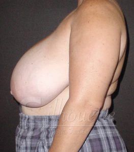 Bakersfield Breast Lift Before and After