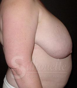 bakersfield, ca breast reduction before and after