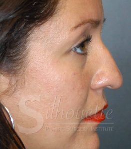 rhinoplasty silhouette plastic surgery