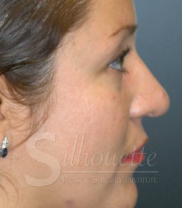 rhinoplasty silhouette plastic surgery