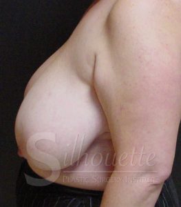 breast reduction silhouette plastic surgery