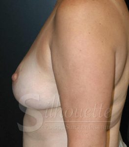 Orange Co Breast Augmentation Before and After