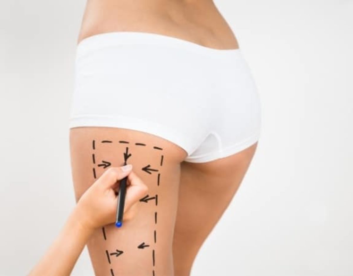 Mons Pubis Liposuction in Hollywood, FL