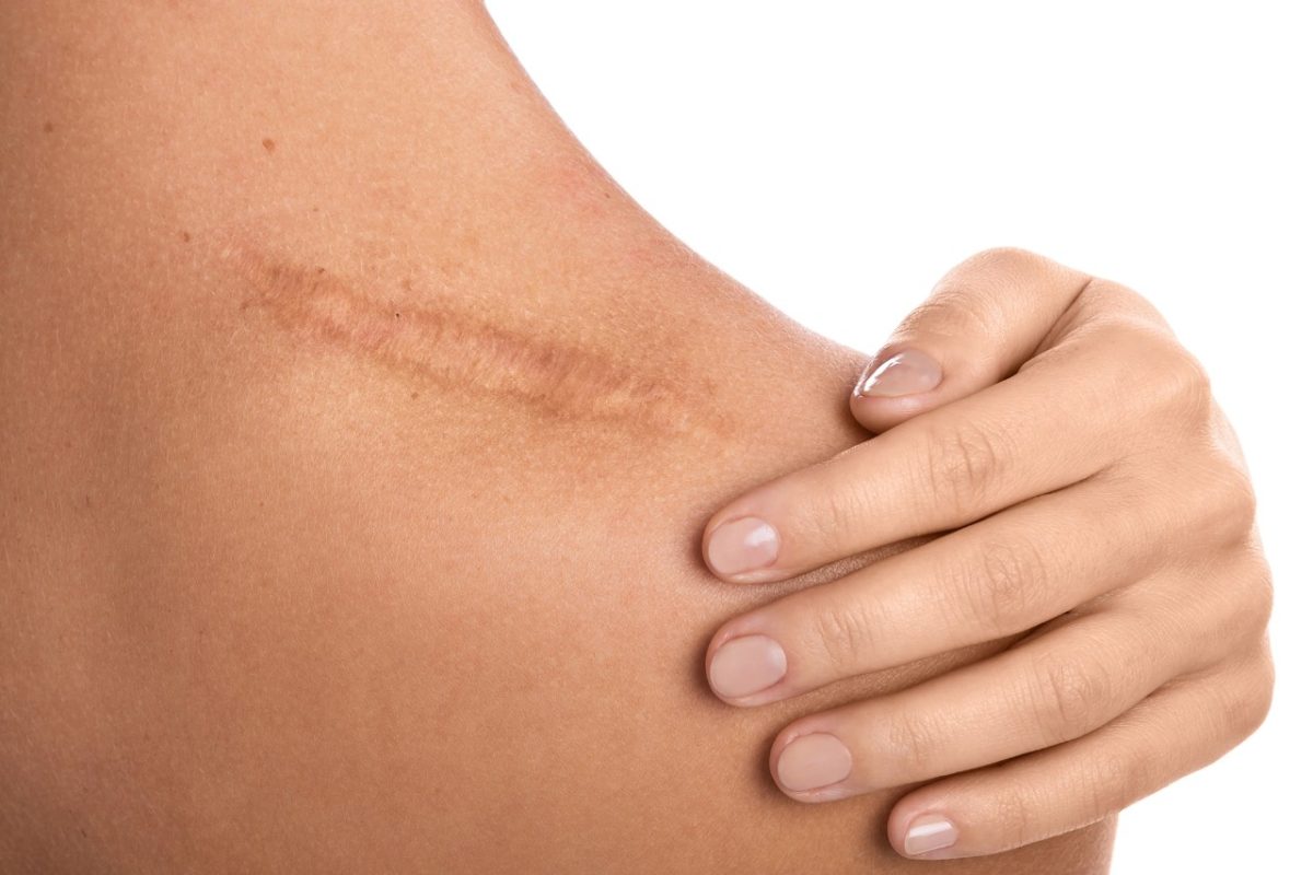 how to get rid of scar tissue
