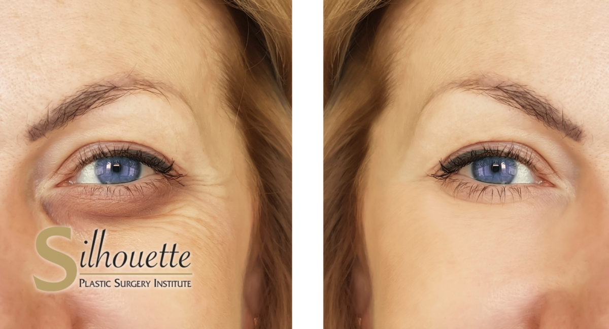 Under Eye Bag Laser Treatment