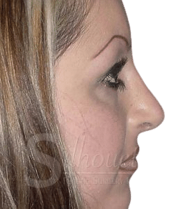 revision rhinoplasty before and after orange co