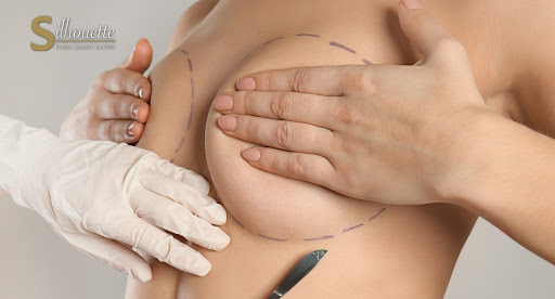C Cup Breasts, Silhouette Plastic Surgery Institute