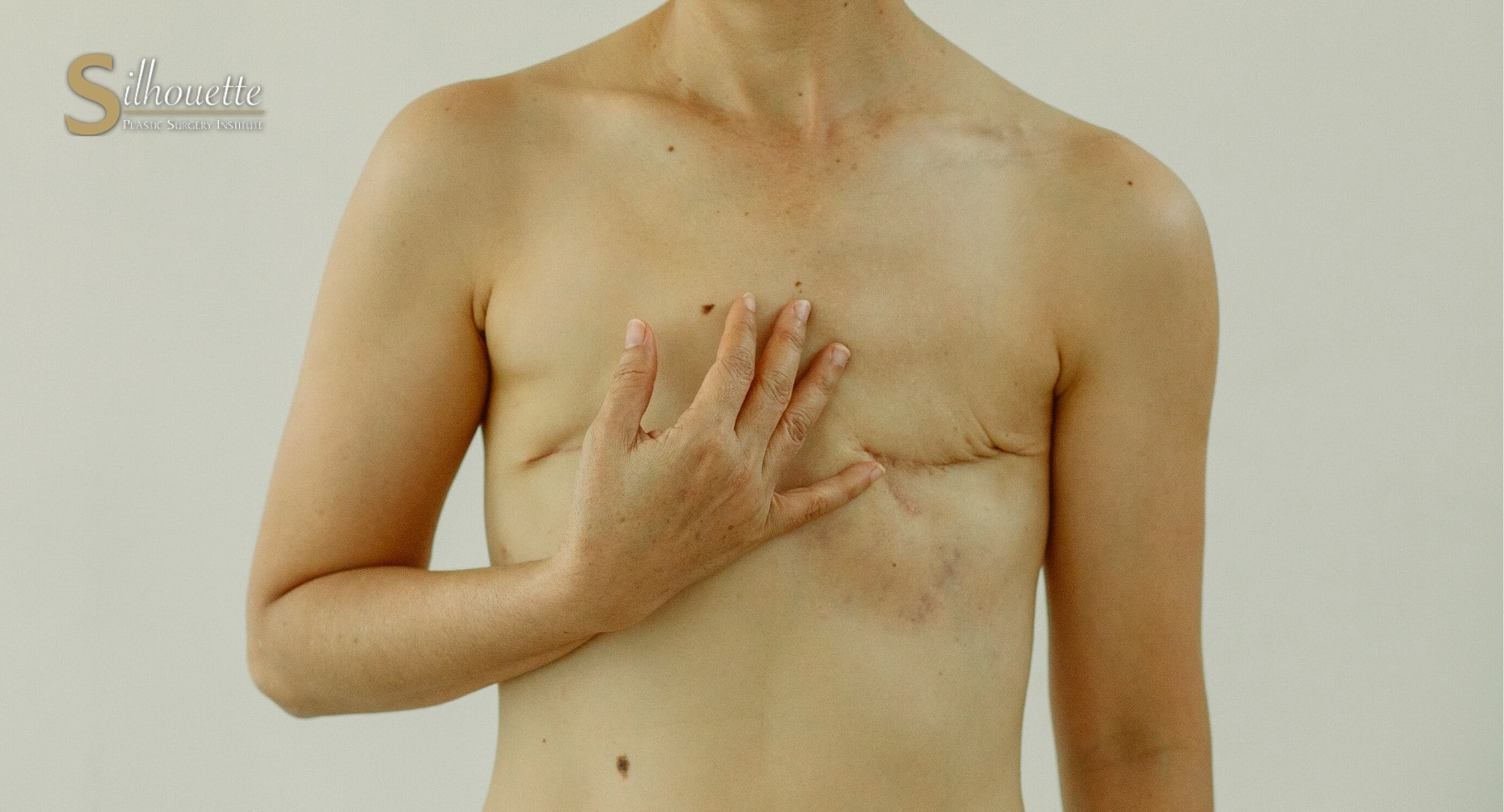 Breast reconstruction after a mastectomy