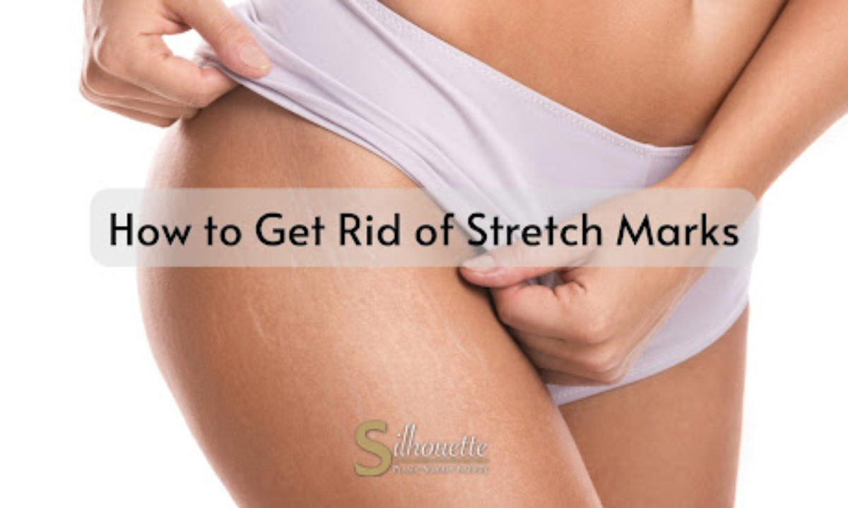 Stretch marks: Why they appear and how to get rid of them