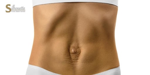 Body FX - Client has Diastasis Recti, also known as abdominal separation,  after her pregnancy. Sometimes depending on the degree of separation, you  will need therapy or surgery to repair the problem.