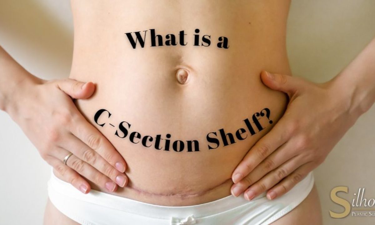 What is a C-Section Shelf?  Silhouette Plastic Surgery Institute
