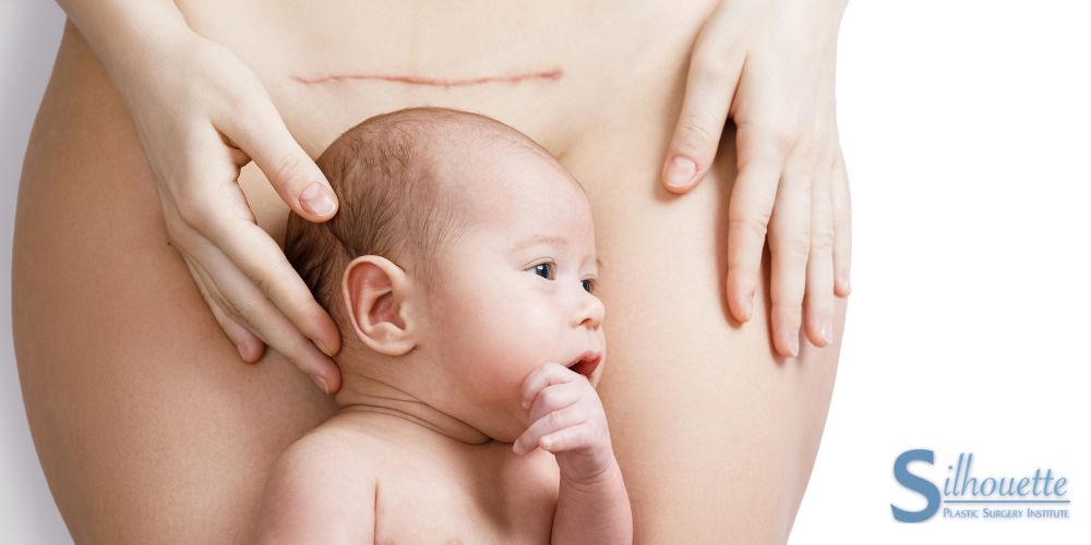 What is a C-Section Shelf?  Silhouette Plastic Surgery Institute