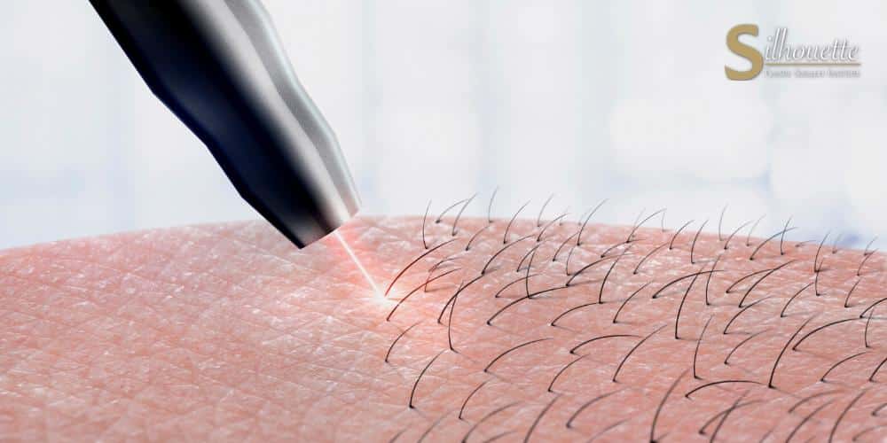 laser vs electrolysis hair removal