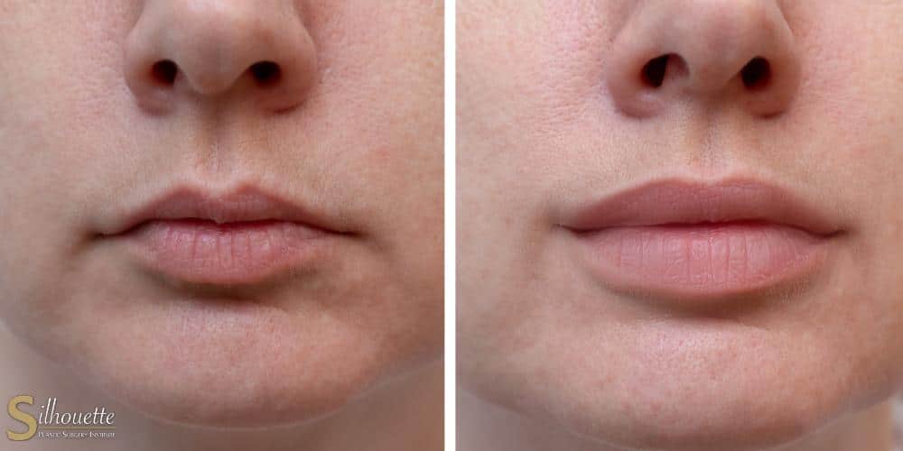 what is juvederm