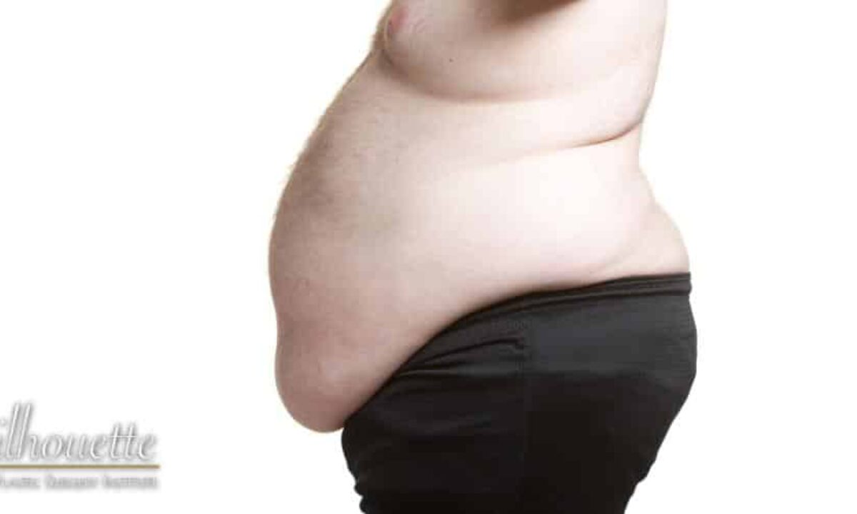 Panniculectomy vs Tummy Tuck