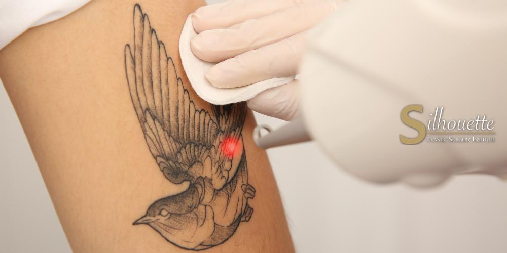 tattoo removal dermabrasion