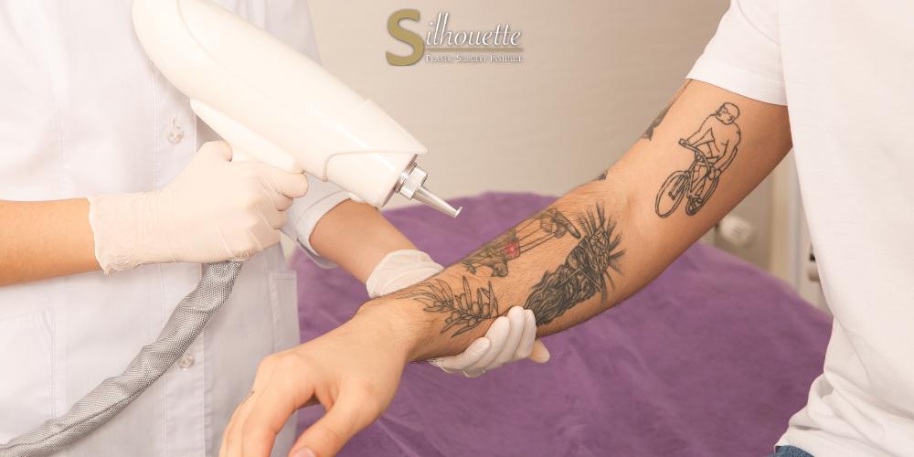 tattoo surgery removal