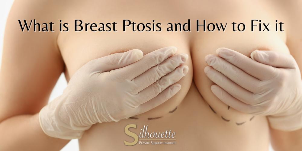 what is breast ptosis