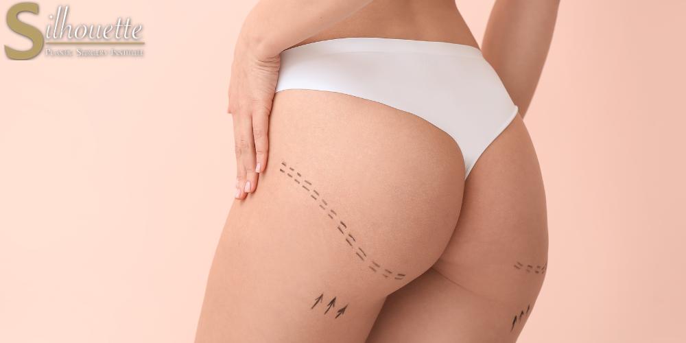 Stretch Marks Removal  Silhouette Plastic Surgery Institute