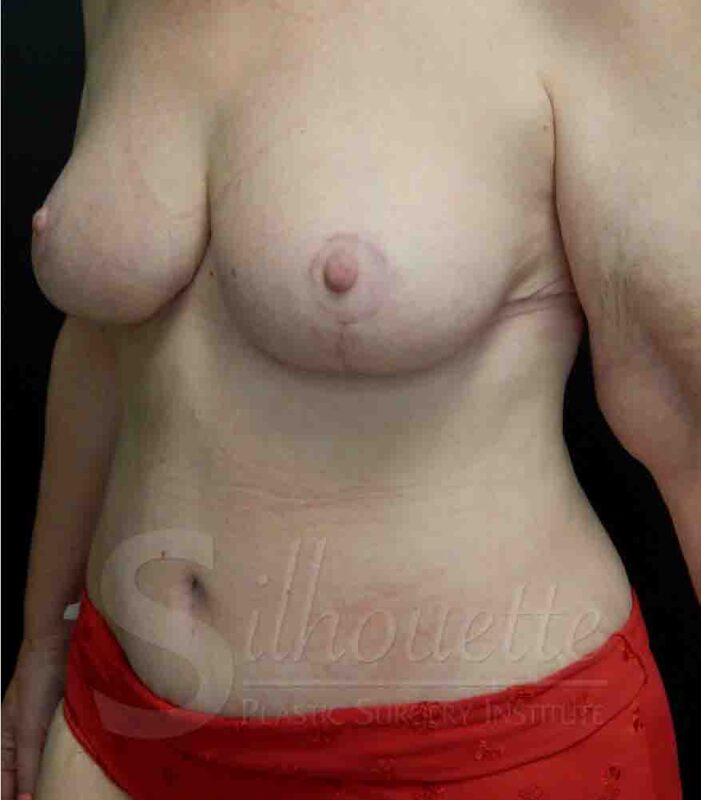 tummy tuck and breast lift case