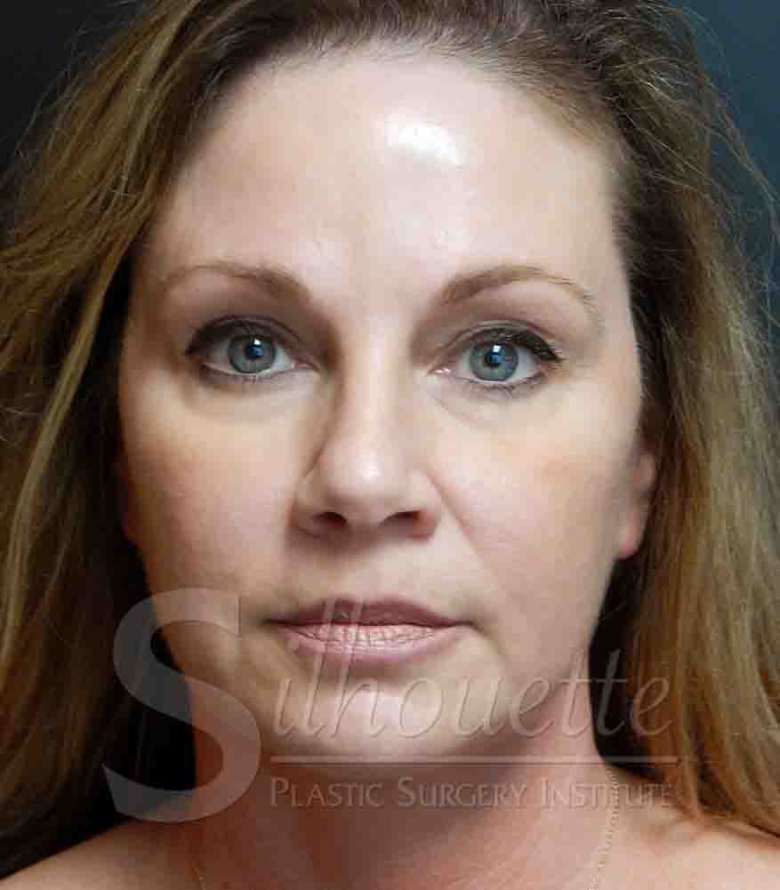 forehead lift case