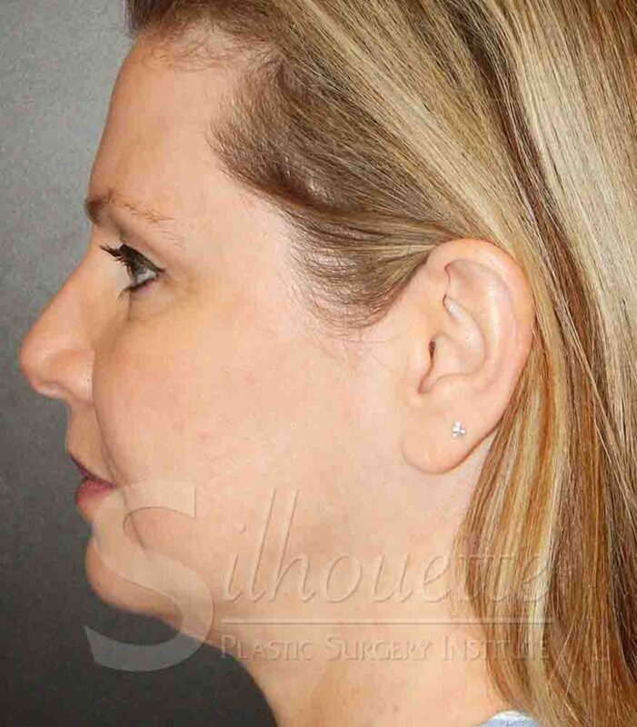 forehead lift case