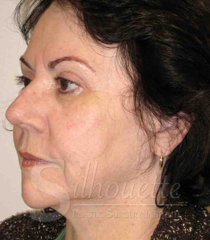 face lift case after first surgery