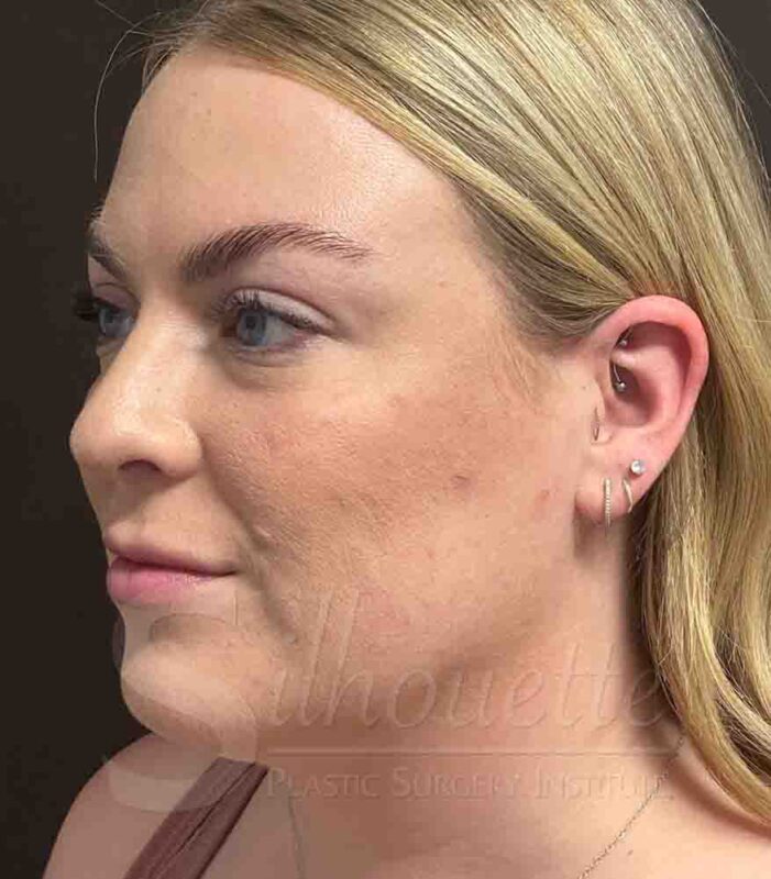 liposuction chin case