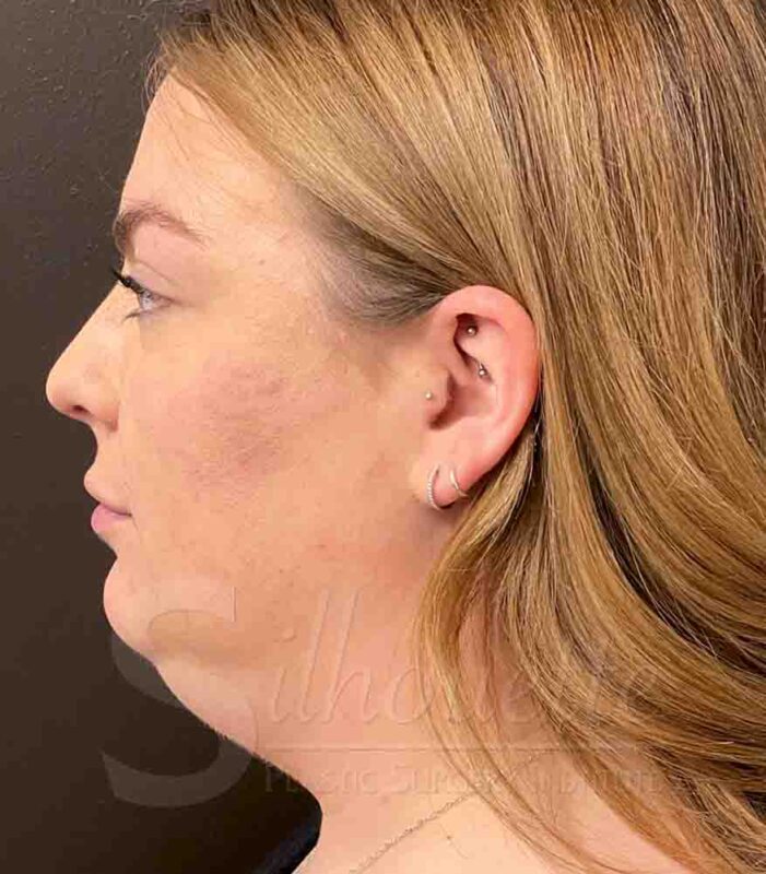 liposuction chin case