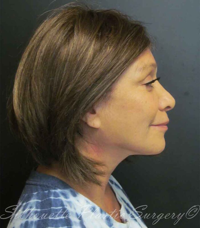face neck lift case