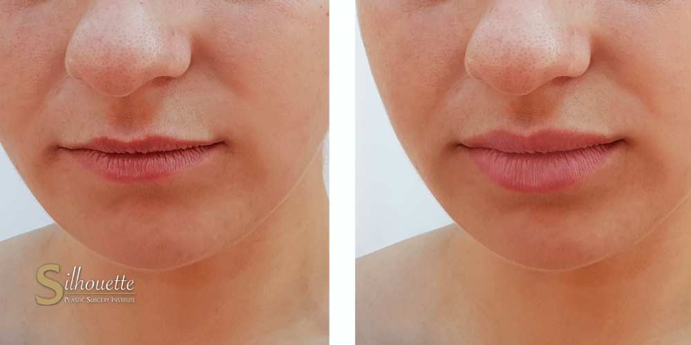 how long does bruising last after lip filler