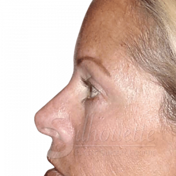 eyelid surgery silhouette plastic surgry