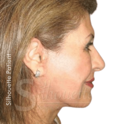 face lift bakersfield